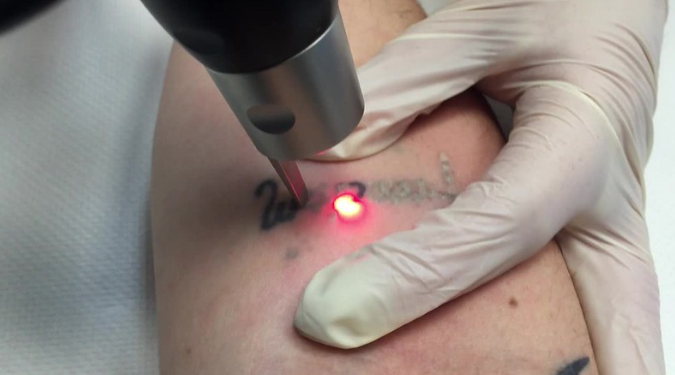 laser tattoo removal